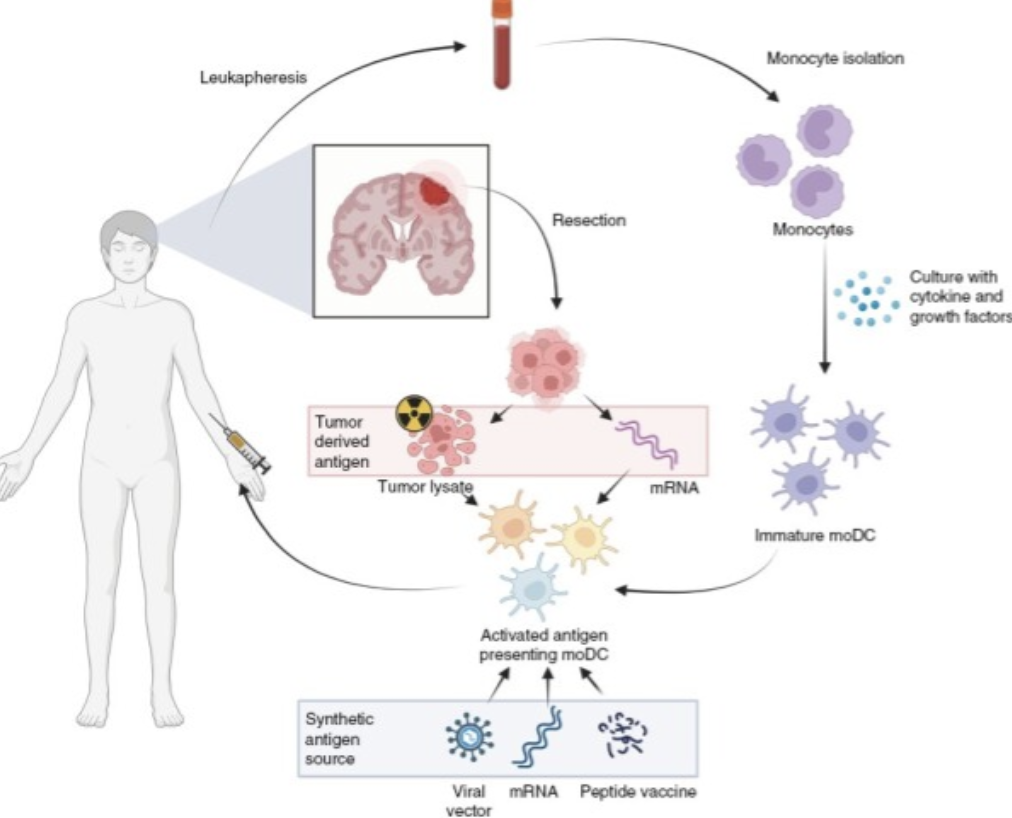 Dendritic cell vaccine trials in gliomas: Untangling the lines